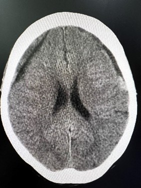 ĐIỀU TRỊ PHẪU THUẬT LẤY MÁU TỤ DƯỚI MÀNG 