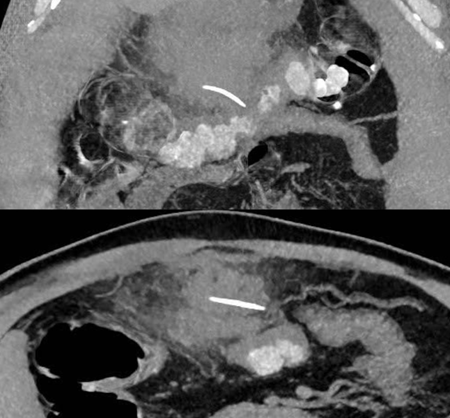 PHẪU THUẬT THÀNH CÔNG 2 TRƯỜNG HỢP XƯƠNG CÁ ĐÂM THỦNG ĐƯỜNG TIÊU HÓA GÂY BIẾN CHỨNG NGUY HIỂM