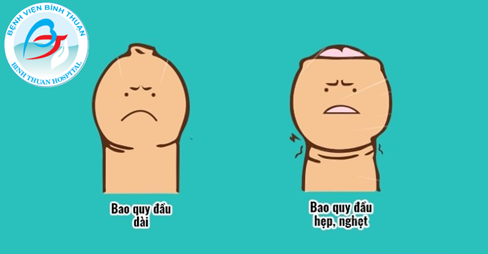 Hẹp Bao Quy Đầu: Khi Nào Cần Điều Trị?