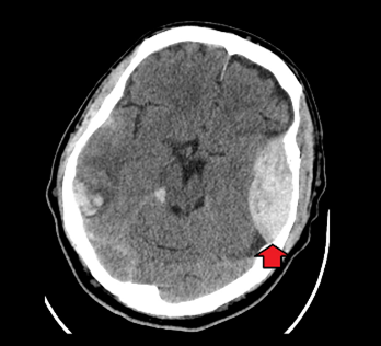 MÁU TỤ NGOÀI MÀNG CỨNG