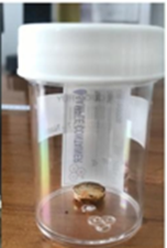 DỊ VẬT PIN ĐIỆN TỬ