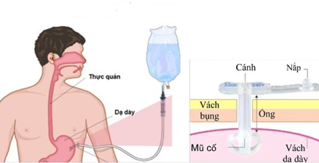 HƯỚNG DẪN CHO NGƯỜI BỆNH UNG THƯ ĂN QUA ỐNG THÔNG DẠ DÀY RA DA TẠI NHÀ