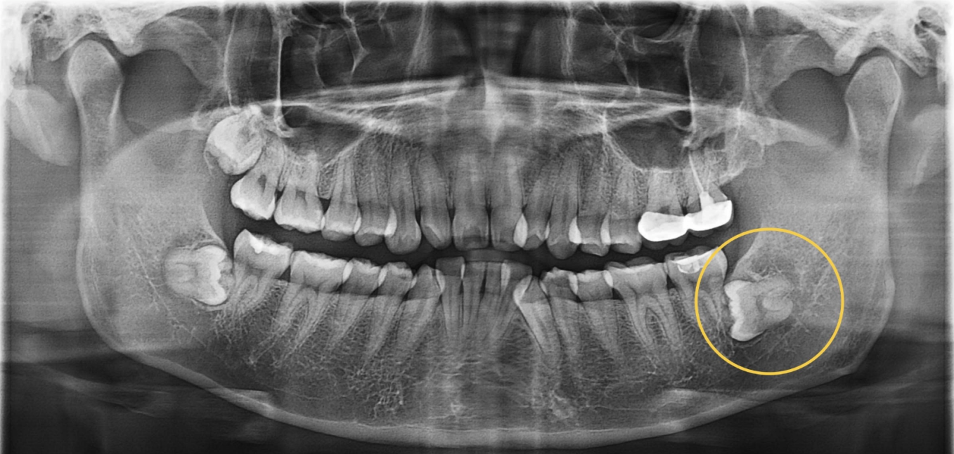 RĂNG KHÔN MỌC LỆCH SÁT DÂY THẦN KINH: 