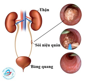 Tán Sỏi Laser: Cách Tiếp Cận Hiện Đại