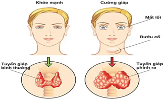 CƯỜNG GIÁP, NHỮNG VẤN ĐỀ BỆNH NHÂN CẦN BIẾT