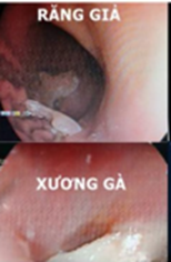 DỊ VẬT ĐƯỜNG ĂN – ĐƯỜNG THỞ