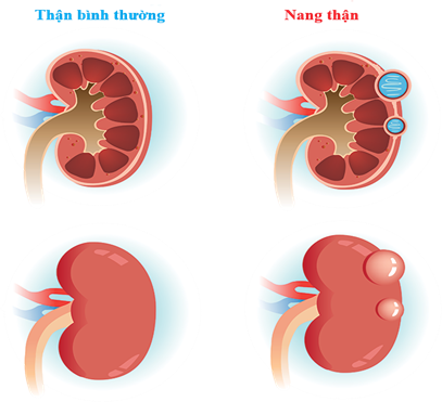 U nang thận: Khối u thầm lặng và những nguy cơ bị bỏ sót