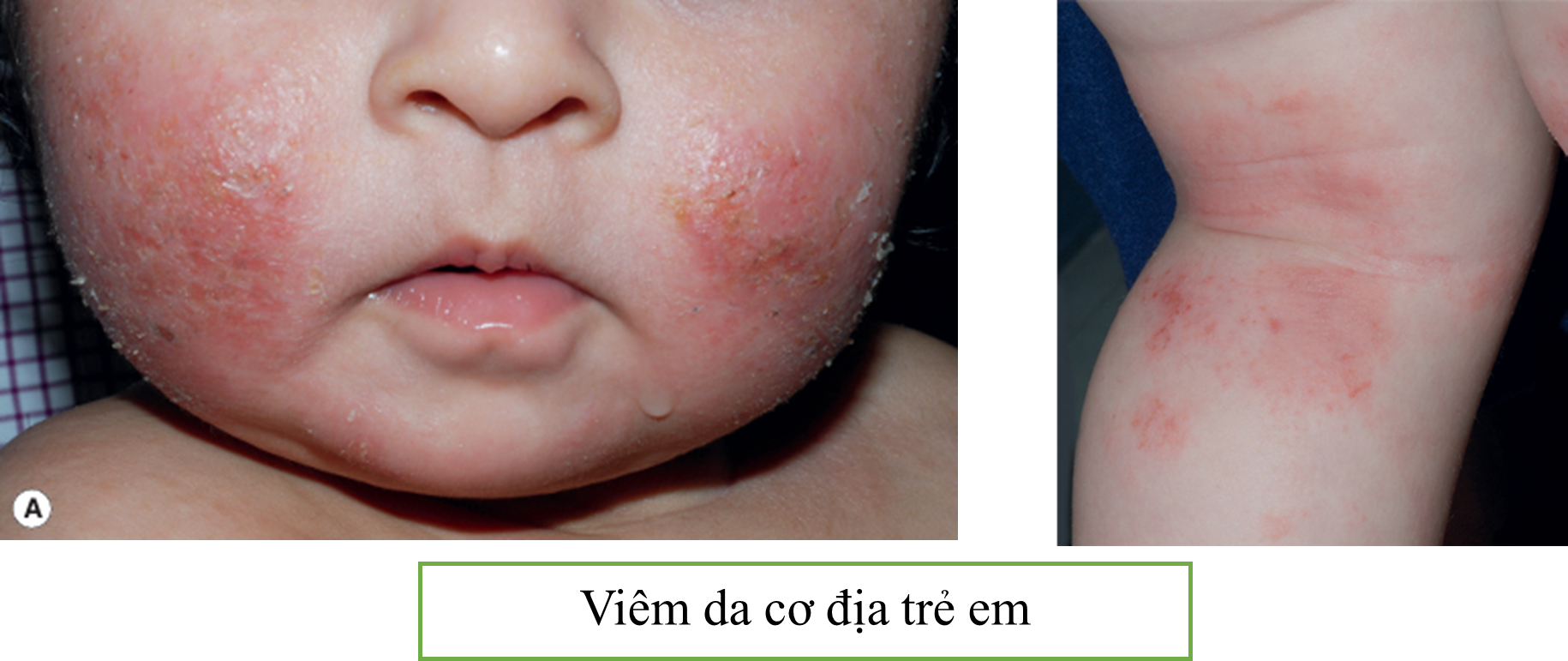 NHỮNG ĐIỀU CẦN BIẾT VỀ VIÊM DA CƠ ĐỊA