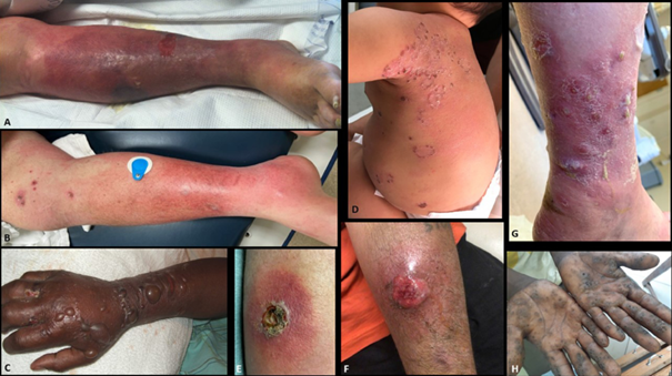 CHĂM SÓC, PHÒNG NGỪA CÁC BỆNH DA LIỄU TRƯỚC, TRONG VÀ SAU MƯA LŨ