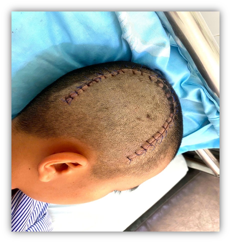 Vết mổ trên đầu bệnh nhi