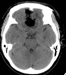 ĐIỀU TRỊ PHẪU THUẬT LẤY U MÀNG NÃO CHO BỆNH NHÂN 44 TUỔI TẠI KHOA NGOẠI THẦN KINH BỆNH VIỆN ĐA KHOA BÌNH THUẬN